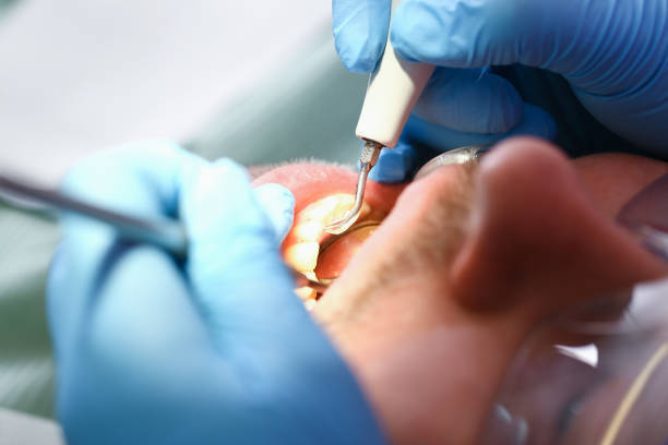 Best Emergency Dental Care for Abscessed Tooth in River Edge, NJ